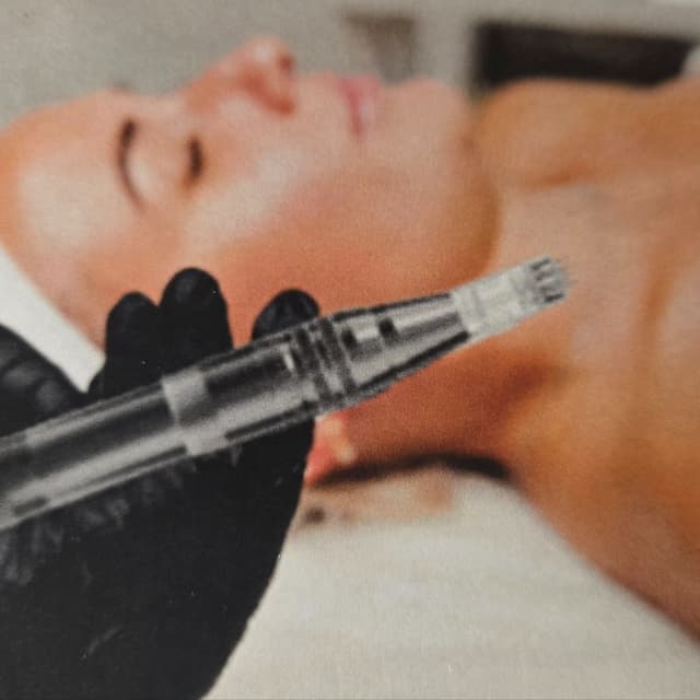 Microneedling package at In Vogue Spa in sudbury, MA